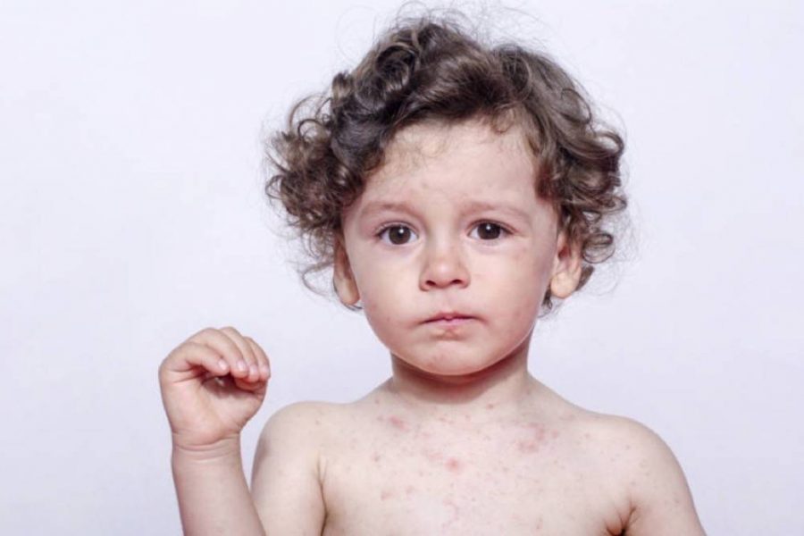 Malattie della pelle e dermatiti: un problema per i più piccoli
