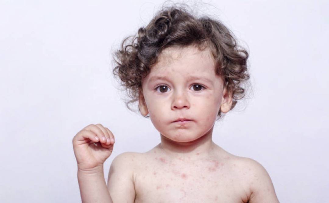 Malattie della pelle e dermatiti: un problema per i più piccoli